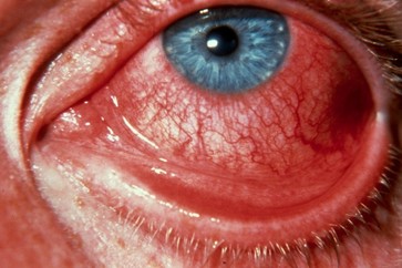 gonorrhea eye treatment